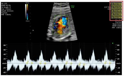 Dual challenge inside the womb: a case report of concomitant fetal atrio-ventricular block associated with maternal anti-SSA antibodies and fetal tachyarrhythmia diagnosed as Wolff-Parkinson-White syndrome after birth
